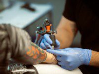 tattoo removed 200x150 1