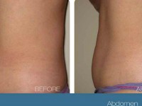 trusculpt before after