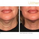 ultherapy 000p 044y before 90daysafter lower 200x150 1  mirabile md - ultherapy 000p 044y before 90daysafter lower 200x150 1