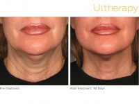 ultherapy 000p 044y before 90daysafter lower 200x150 1