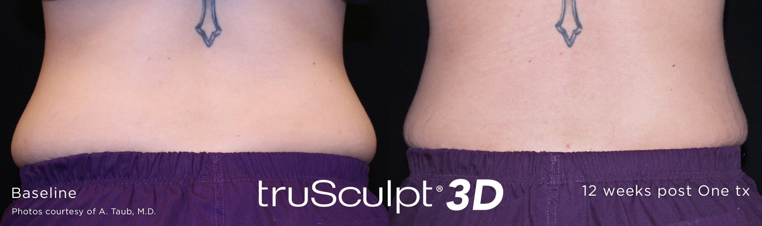 trusculpt 3d lovehandlesbeforeafter scaled