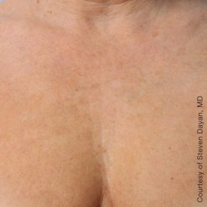 Ultherapy AFTER