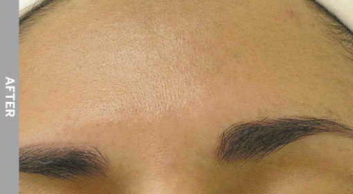 hydrafacial Hyperpigmentation After