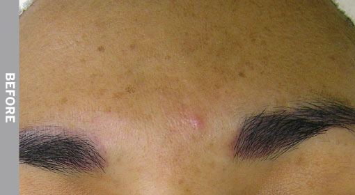 hydrafacial Hyperpigmentation Before