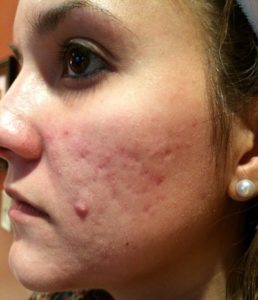 Acne scar before Skin Pen II