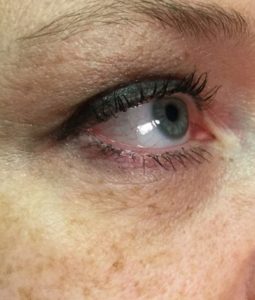 Microneedling with infusion after eye