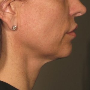 Ultherapy After