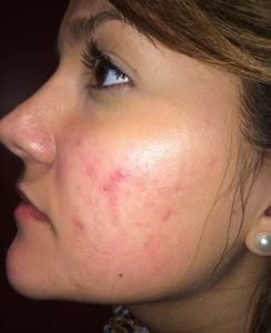 acne scar after Skin Pen II