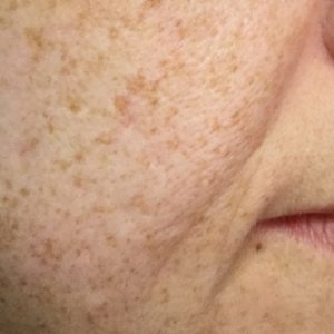 microneedling with infusion after lower face