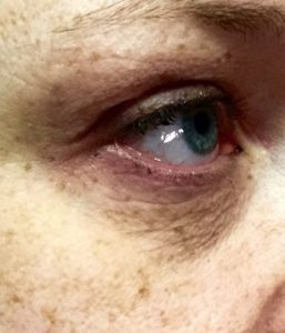 microneedling with infusion before eye