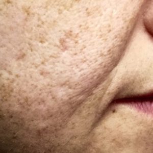 microneedling with infusion before lower face
