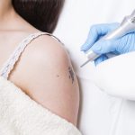 laser tattoo removal treatment scaled