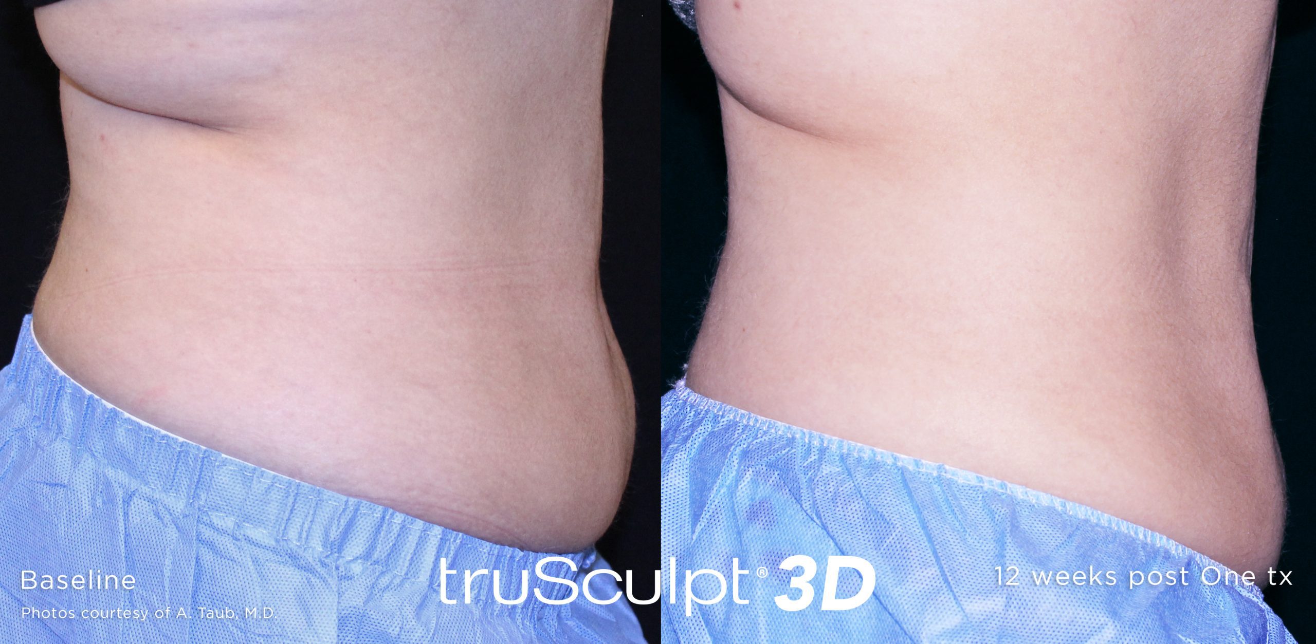 trusculpt 3d beforeandafter scaled