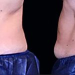 newtrusculptb4after2