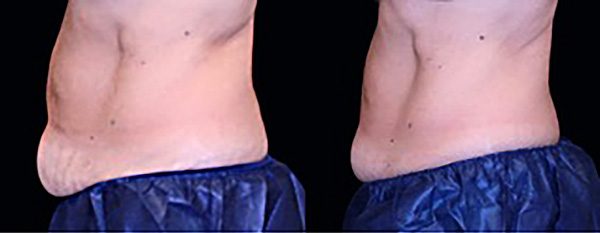 newtrusculptb4after2