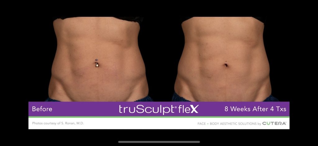 trusculpt flex