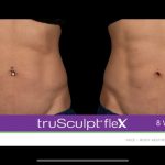 trusculptflex