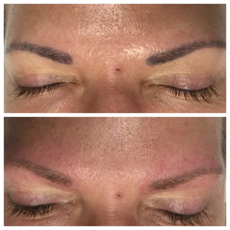 Cutera - One treatment with the Enlighten tattoo removal laser and this is  the result! This technology has the ability to halve the number of  treatments that other technologies may require! Thanks