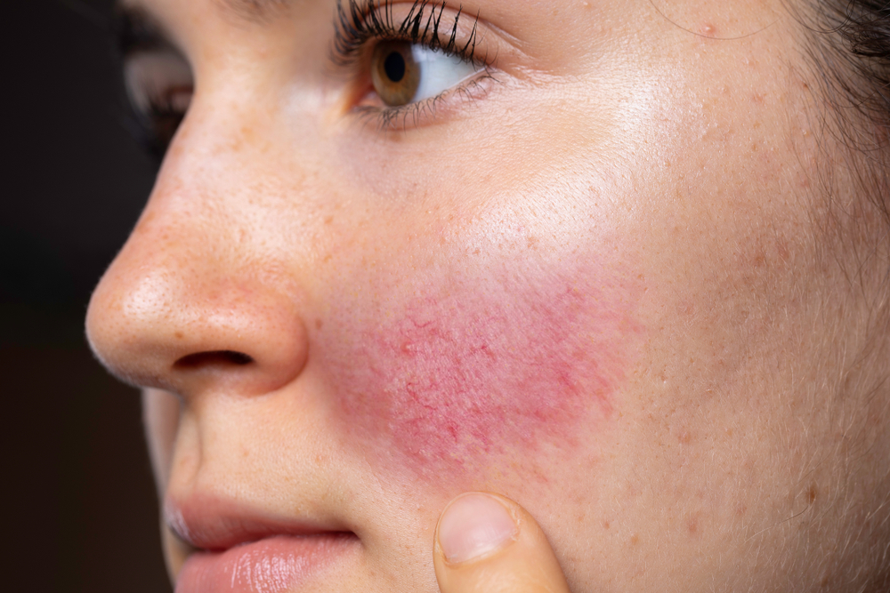 rosacea