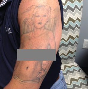 Laser Tattoo Removal in Los Angeles Newport Beach and San Diego  California  South Coast MedSpa and Surgical Center