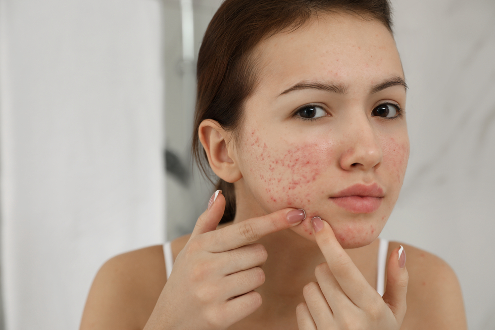 close up of a woman's face with acne