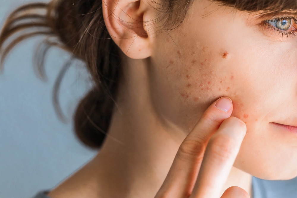 close up of a woman with acne on her cheek