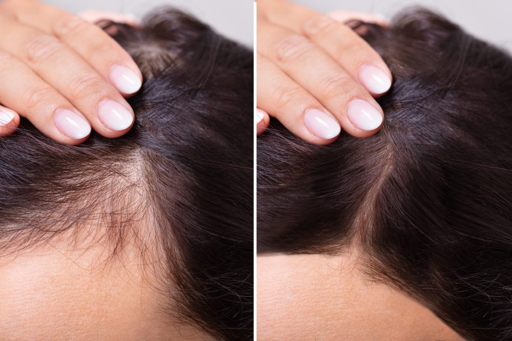 womanbeforeandafterhairlosstreatment mirabile md - prf hair loss treatment before and after