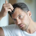prf hair loss treatment 3 mirabile md - prf hair loss treatment 3