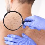 where do sunspots come from 3 mirabile md - where do sunspots come from 3