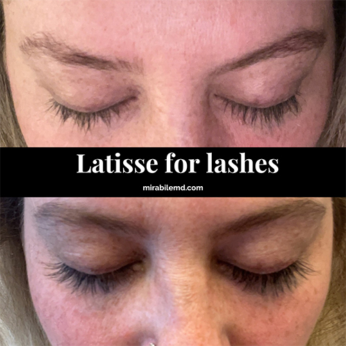latisse mirabile md -