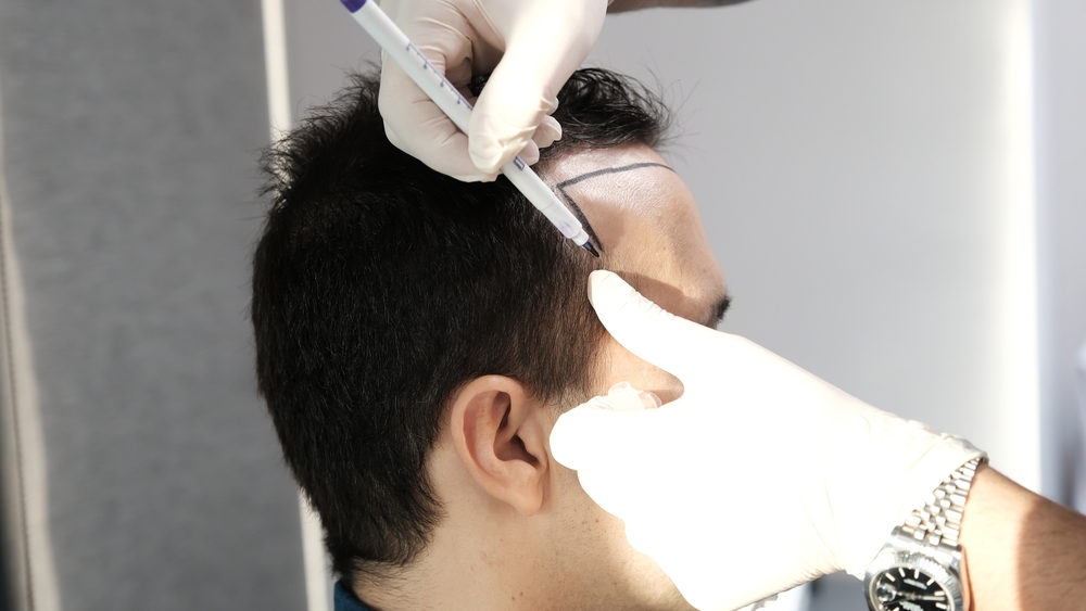 man getting PRF hair restoration
