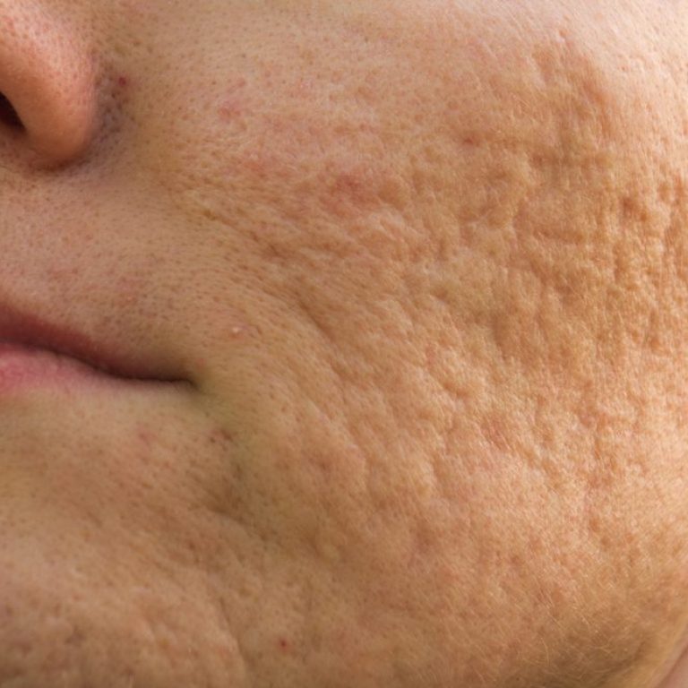 acne scars