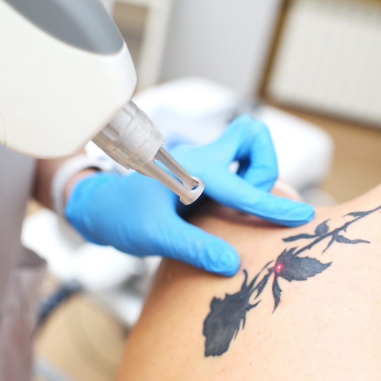 guide to laser tattoo removal scaled 3