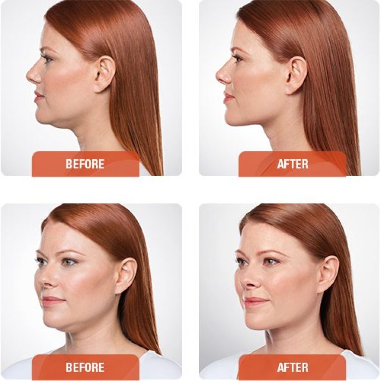 images before and after kybella