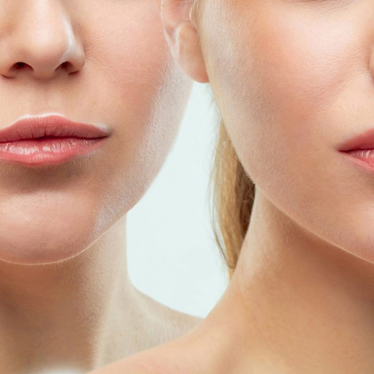 lip flip with botox 3 scaled