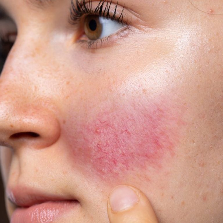 rosacea