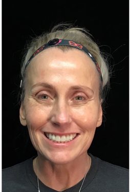 sculptra front smile after heather