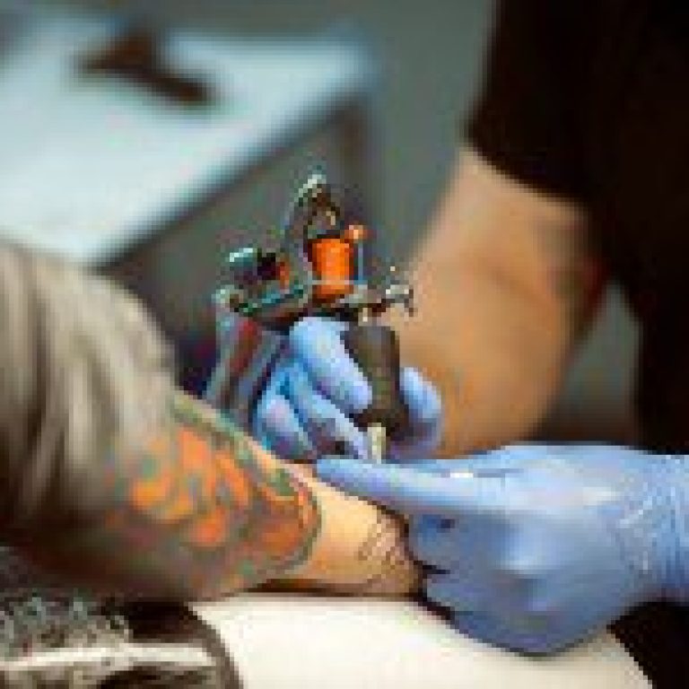 tattoo removed 200x150 1