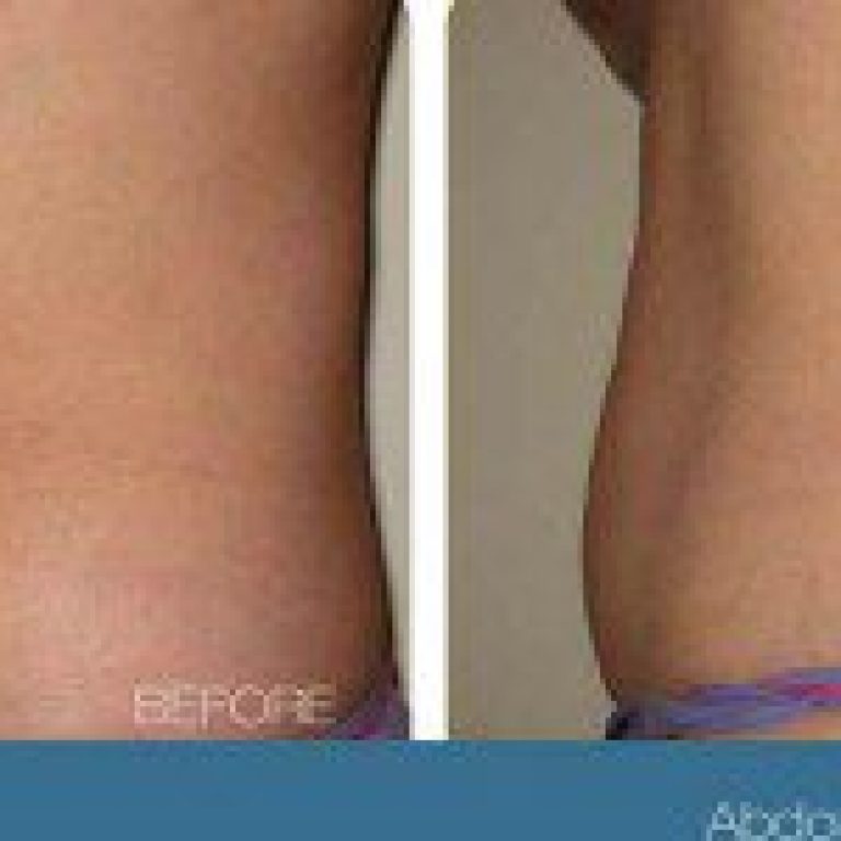 trusculpt5 01 200x150 1