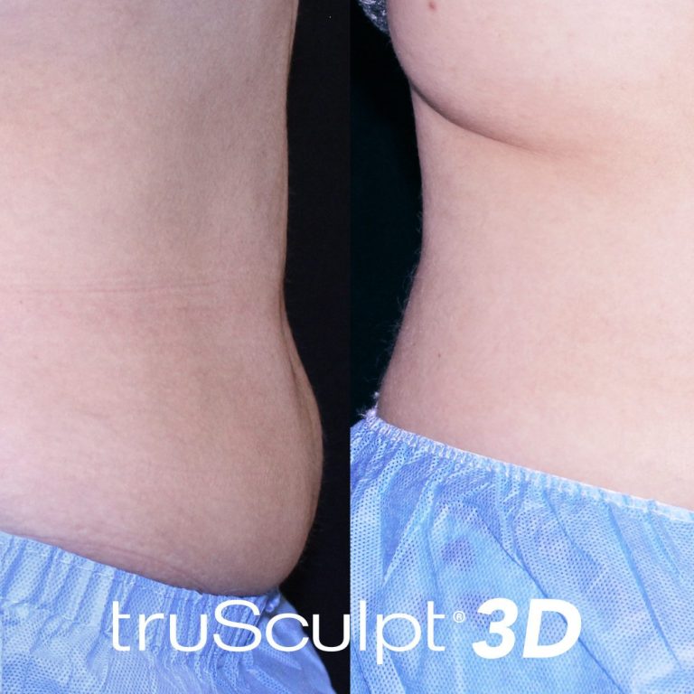 trusculpt 3d beforeandafter scaled