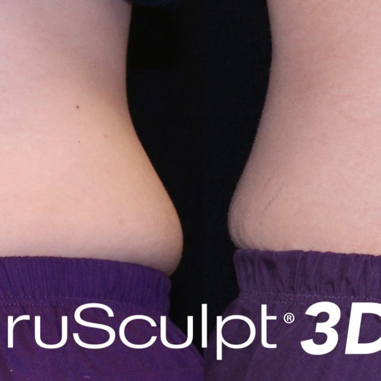 trusculpt 3d lovehandlesbeforeafter scaled