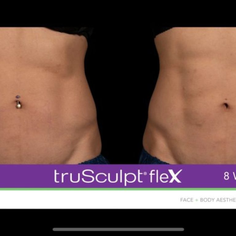 trusculptflex