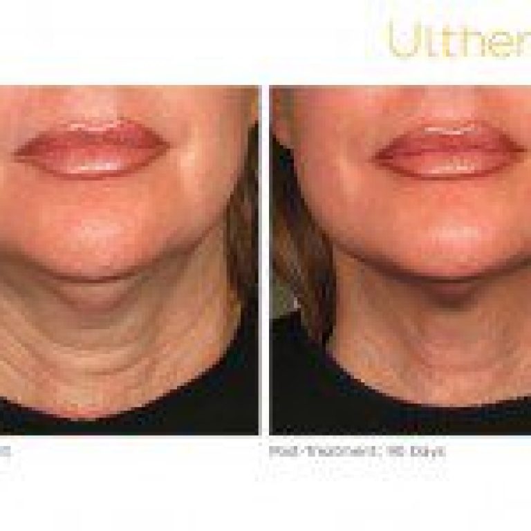 ultherapy 000p 044y before 90daysafter lower 200x150 1